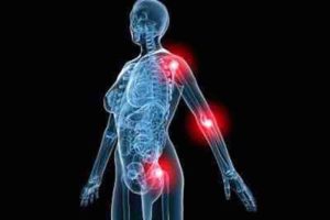 Bone & Joint Pain in MPN Patients Explained