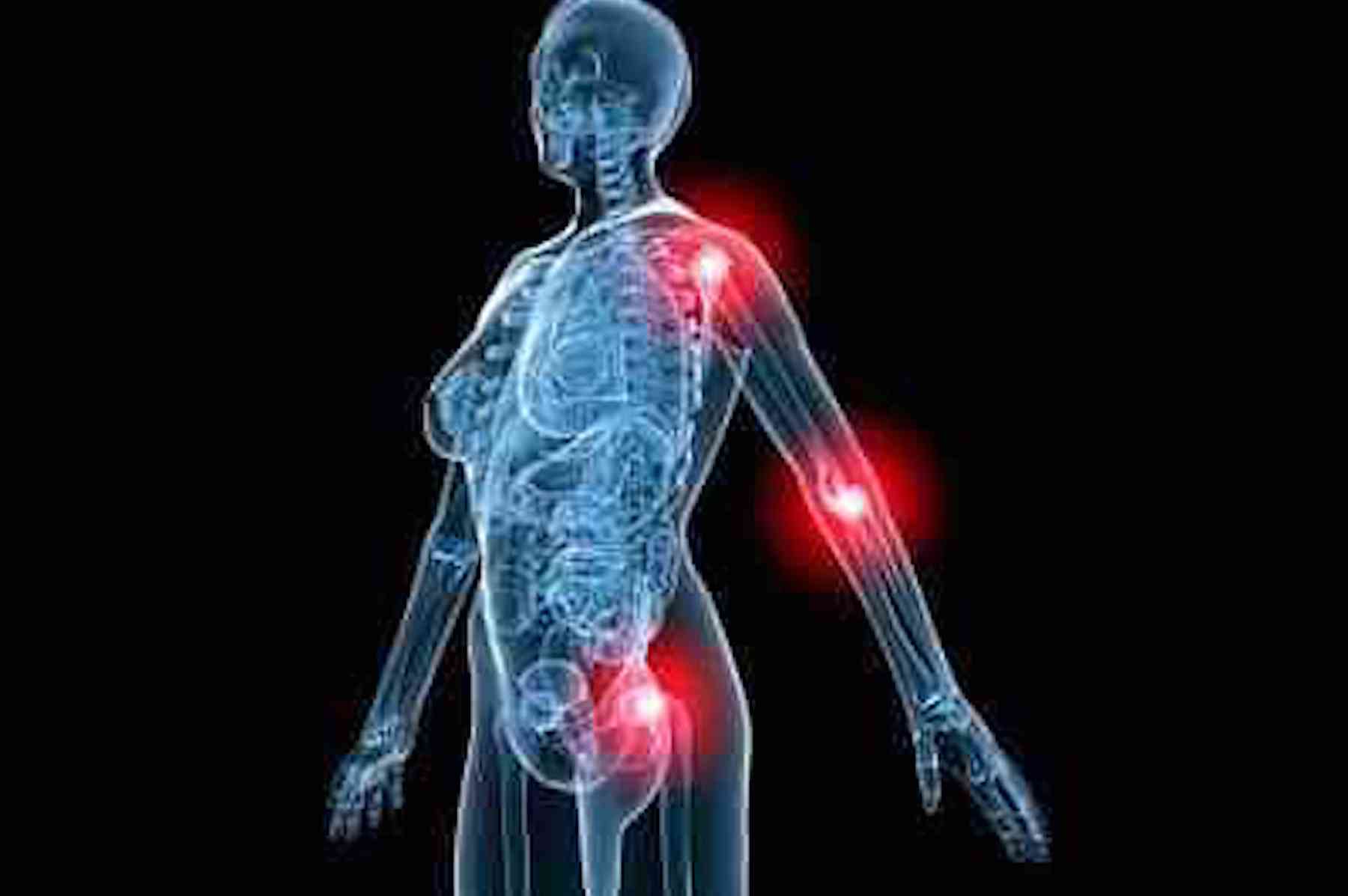 Bone & Joint Pain In MPN Patients Explained | Proliferative | PV Reporter