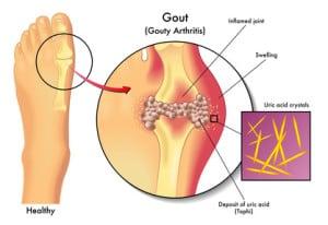 gout in mpn