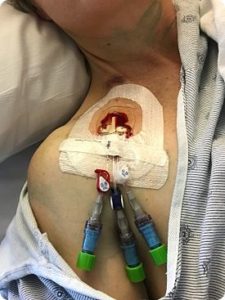 What I Learned from going through Stem Cell Transplant for Myelofibrosis 3 vas catheter first day