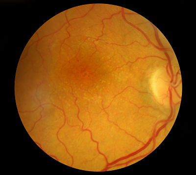 age related macular degeneration in MPN
