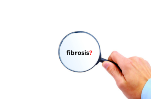 fibrosis in myelofibrosis