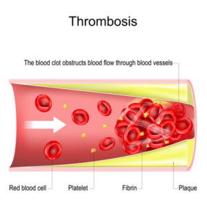 thrombosis in MPNs